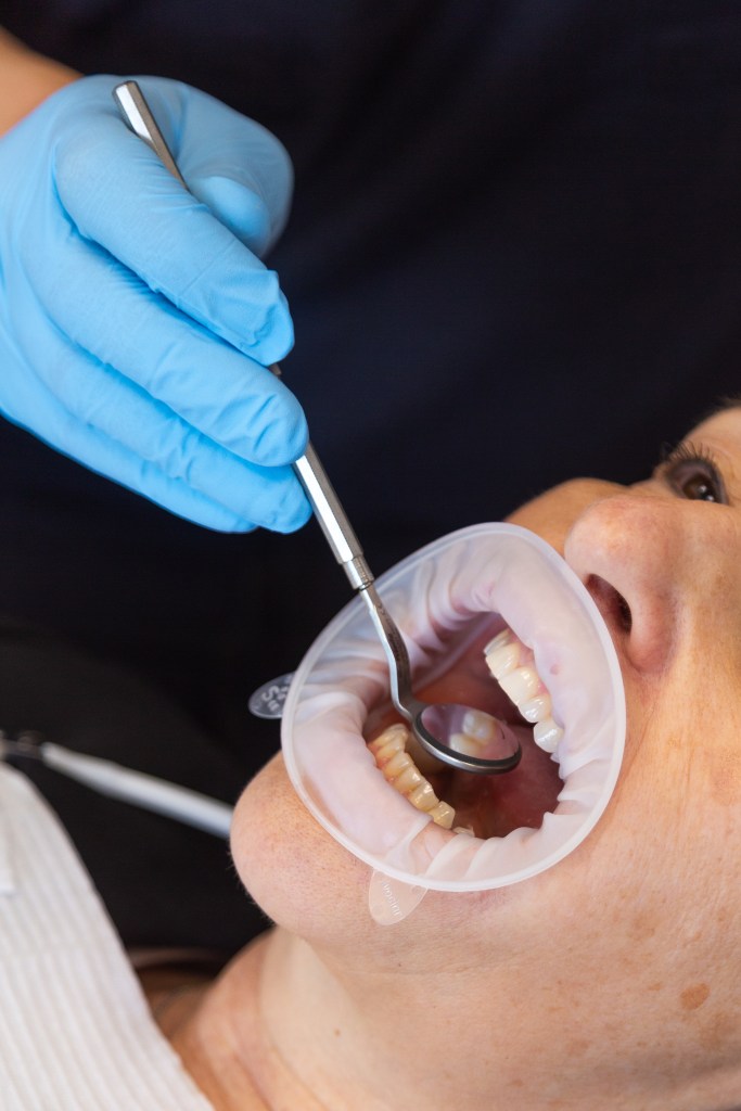 Un professionnel dentaire examine les dents d'un patient allongé, avec un miroir dentaire et un protège-bouche en silicone.